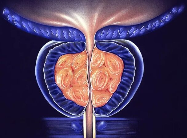 Prostatite batterica cronica negli uomini